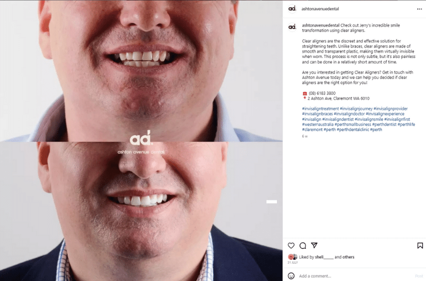 marketing of clear aligners in Australia